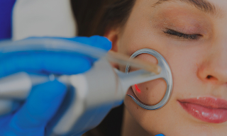 CO2 Laser Treatment